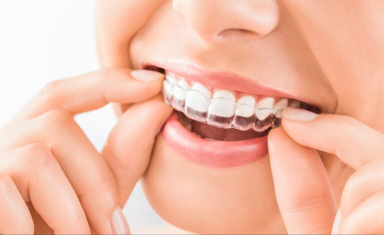 The Benefits of Invisalign for Teens