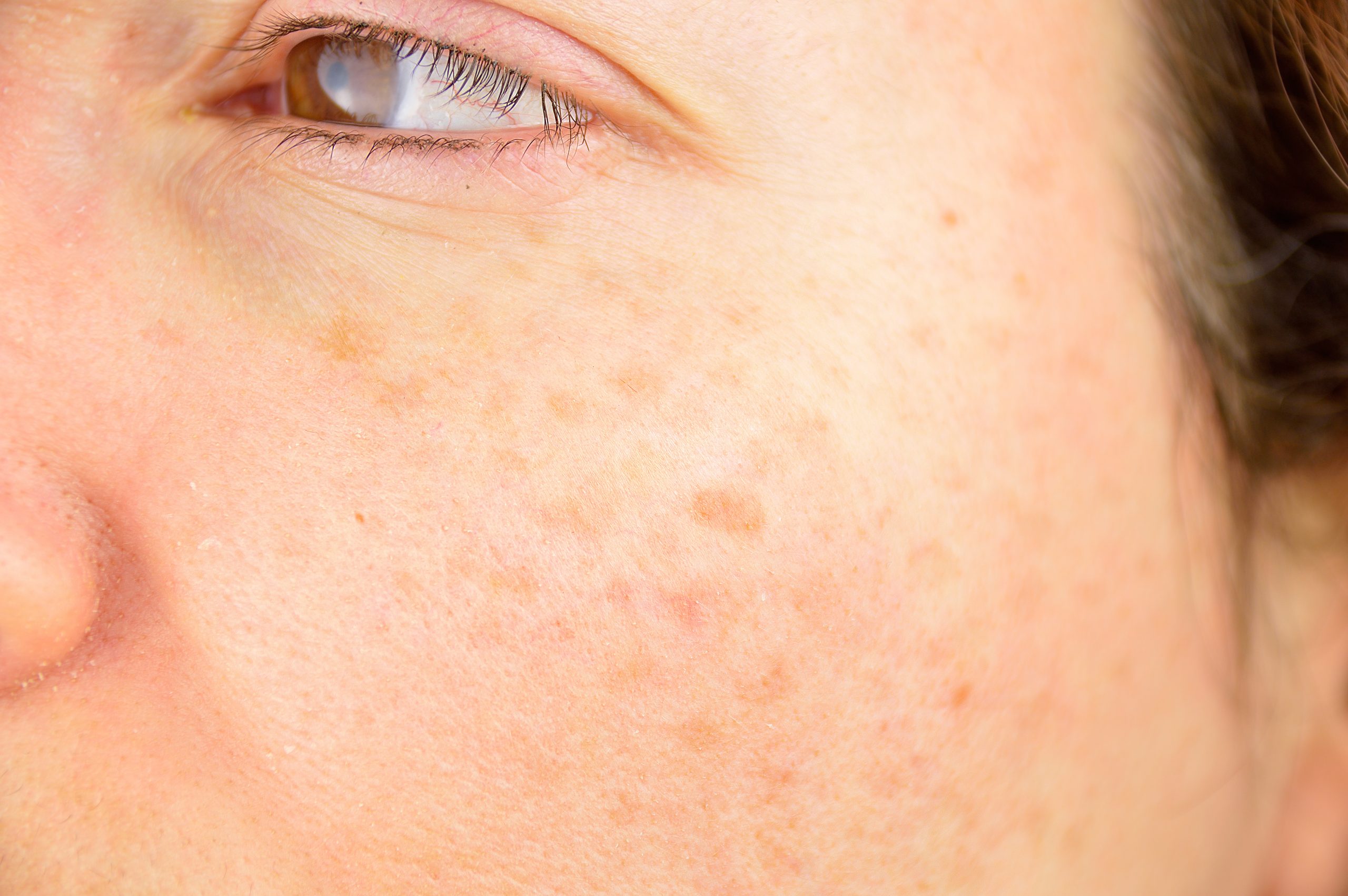The Connection Between Skin Cancer and Sun Exposure