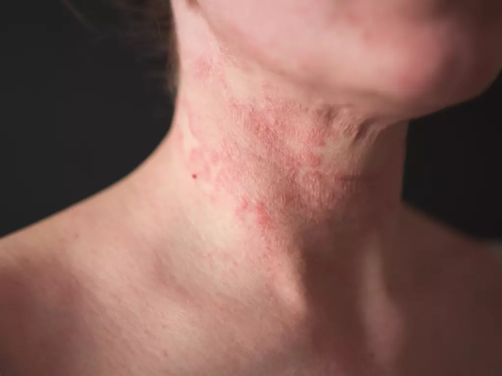 The Different Types of Eczema and Their Symptoms