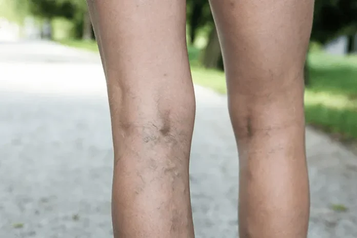 The Effects of Varicose Veins