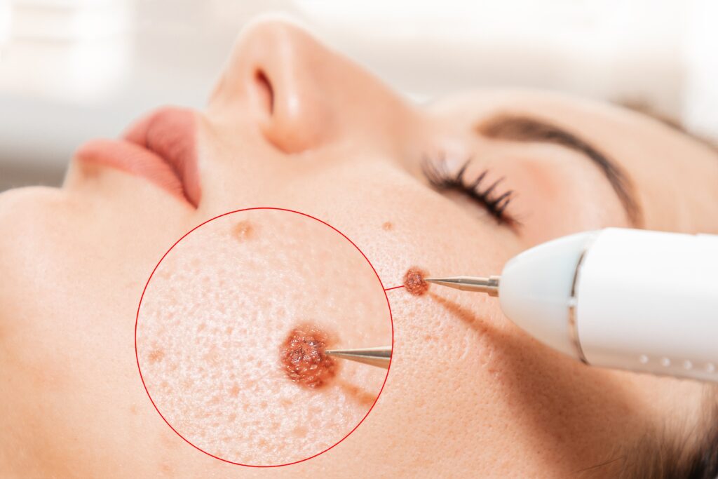 The Role of Mohs Surgery in Skin Cancer Treatment