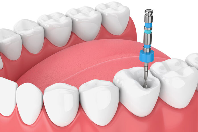 What To Expect During a Root Canal Procedure