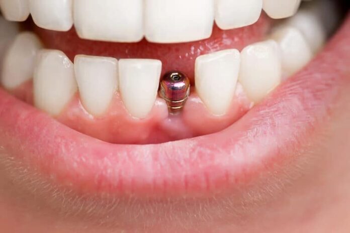 What To Expect During and After Dental Implants