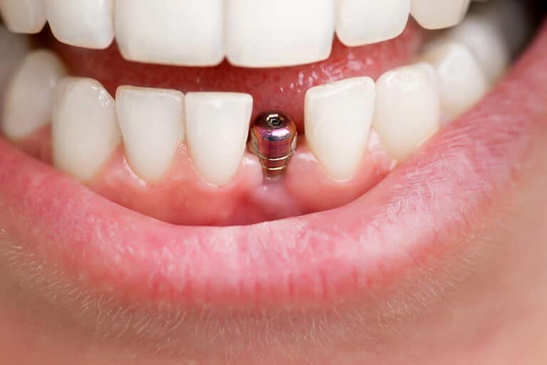 What To Expect During and After Dental Implants