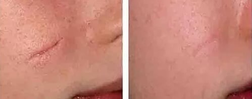 What To Expect at a Scar Correction Appointment