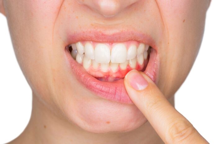 A Comprehensive Guide To Gum Treatments For Healthier Gums