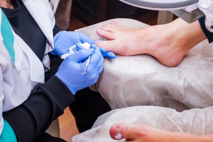 Managing Recurring Ingrown Toenails