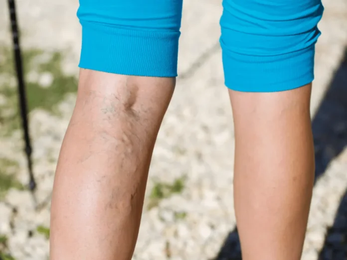 Managing Varicose Veins After Pregnancy