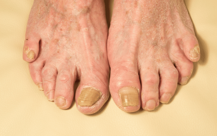 Natural Remedies for Treating Fungal Nails