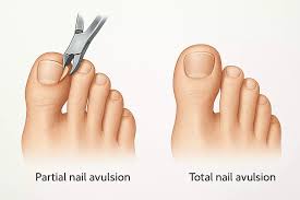 Tips for Finding Relief From Ingrown Toenails