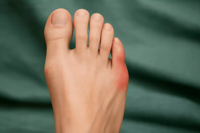 Treatments for Severe Bunion Cases