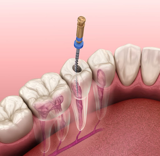 Understanding the Recovery Process After a Root Canal