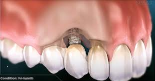 Why You Should Consult a Dental Implant Specialist for Tooth Loss
